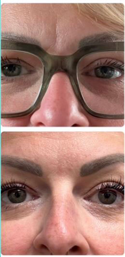 Before and after image of a browlift treatment preformed by Wellness & Aesthetics by WHEN.