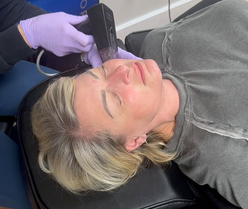 Woman experiencing face microneedling treatment at Wellness & Aesthetics by WHEN.