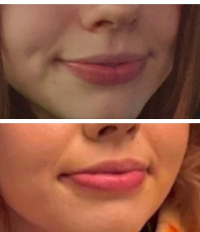 Before and after image of a lip filler top lip treatment preformed by Wellness & Aesthetics by WHEN.