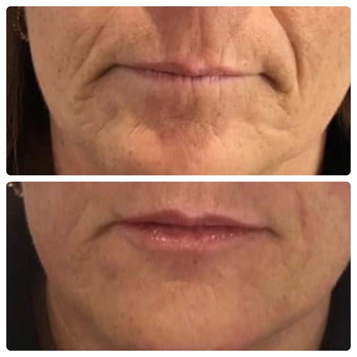 Before and after image of a lip filler treatment preformed by Wellness & Aesthetics by WHEN.