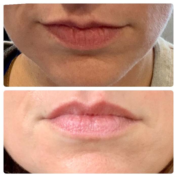 Before and after image of a lip flip teatment preformed by Wellness & Aesthetics by WHEN.