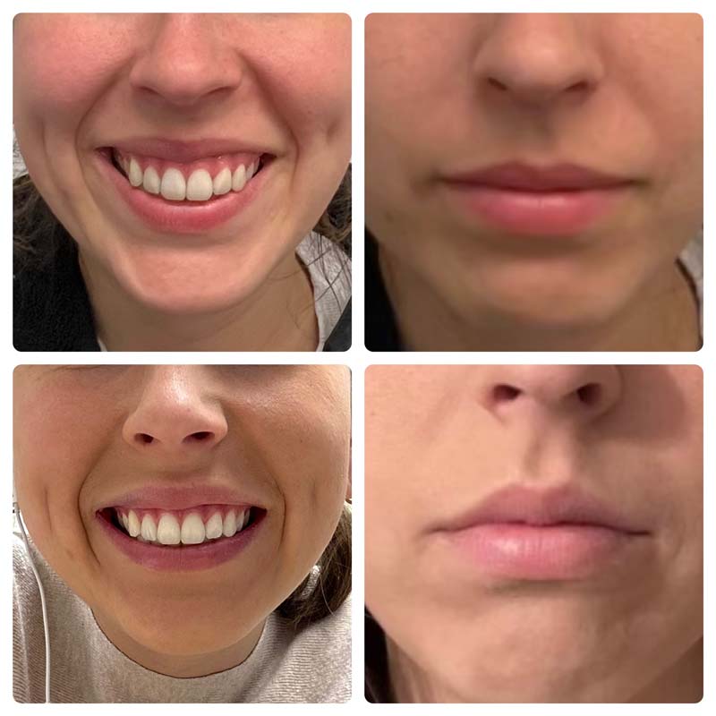 Before and after image of a lip threading and a lip flip treatment preformed by Wellness & Aesthetics by WHEN.