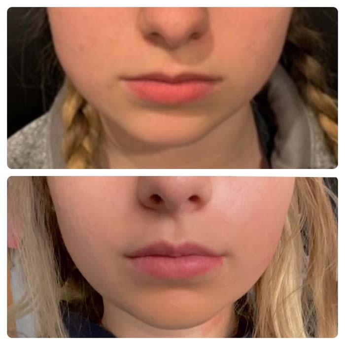 Before and after image of a lip flip treatment preformed by Wellness & Aesthetics by WHEN.