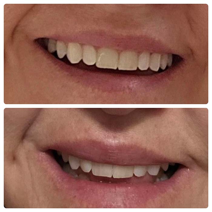 Before and two months after image of a PRF lip treatment preformed by Wellness & Aesthetics by WHEN.